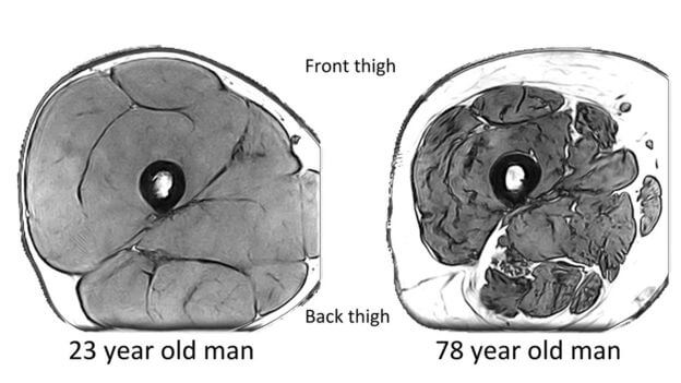 MRI images of the mid-thigh in a 23-year-old man and a 78-year-old