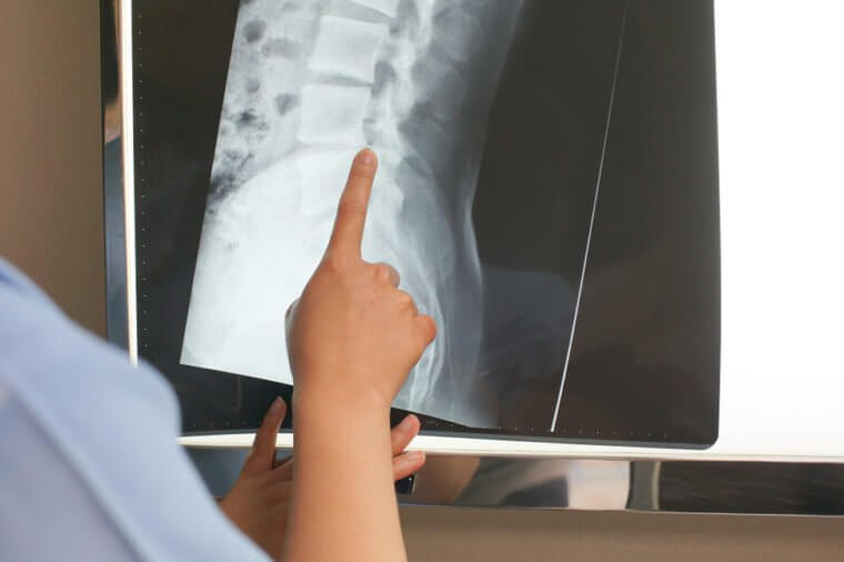 closeup of professional doctor examining x-ray film of patient. medical and healthcare concept.